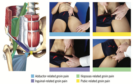 Pubic Syndrome: what it is and how we treat the most common conditions. -  Espregueira Clinical Academy